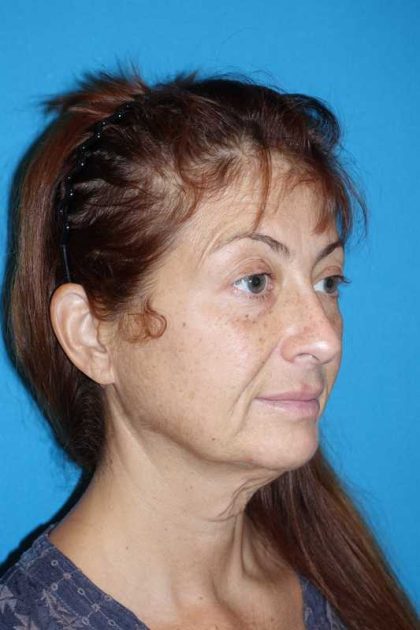 Deep Plane Lower Face & Neck Lift Before & After Patient #1052