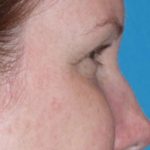 Eyelid Lift- Lower Before & After Patient #742