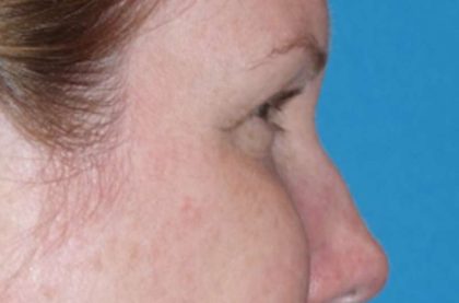 Eyelid Lift- Lower Before & After Patient #742