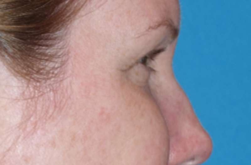 Eyelid Lift- Lower Before & After Patient #742
