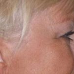 Eyelid Lift- Upper Before & After Patient #754