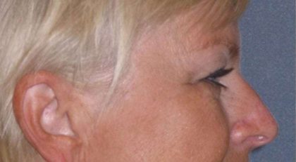 Eyelid Lift- Upper Before & After Patient #754