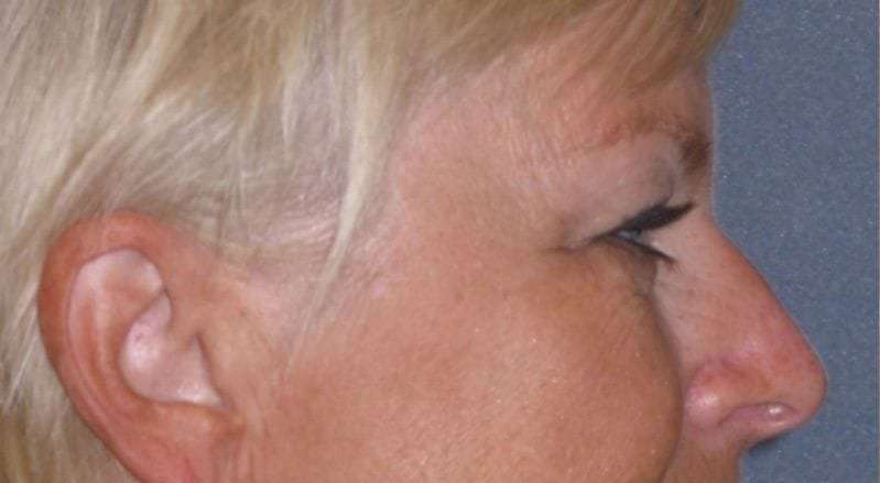 Eyelid Lift- Upper Before & After Patient #754