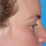 Eyelid Lift- Upper Before & After Patient #765
