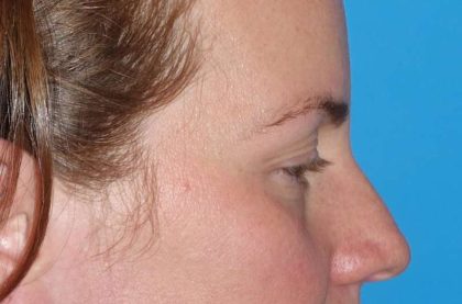 Eyelid Lift- Upper Before & After Patient #765
