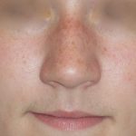Rhinoplasty Before & After Patient #787