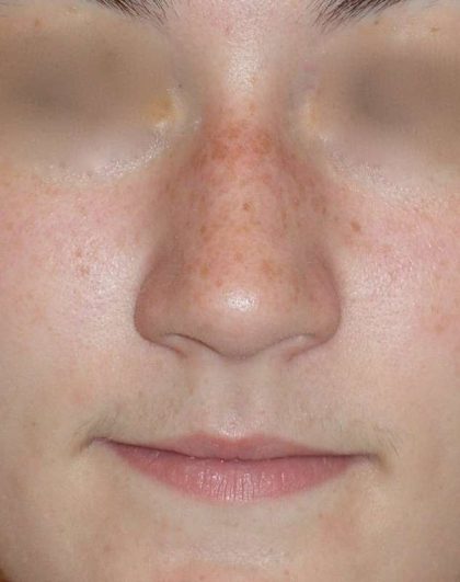 Rhinoplasty Before & After Patient #787