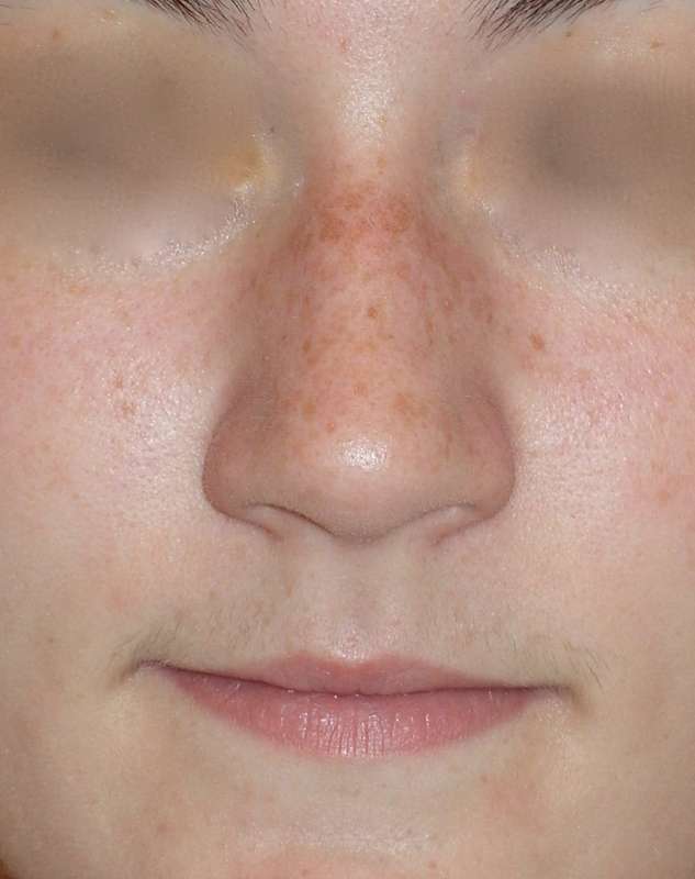 Rhinoplasty Before & After Patient #787