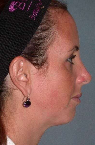 Fraxel Restore Before & After Patient #677