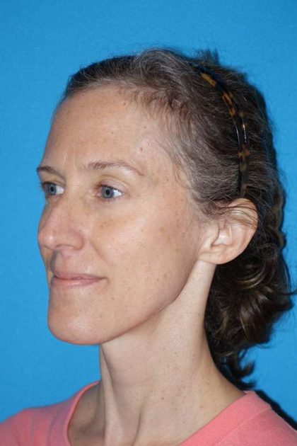 Rhinoplasty Before & After Patient #834