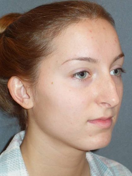 Rhinoplasty Before & After Patient #845