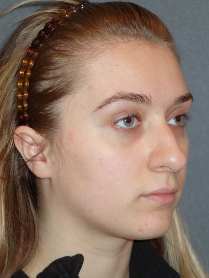 Rhinoplasty Before & After Patient #856