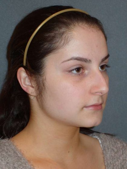 Rhinoplasty Before & After Patient #867