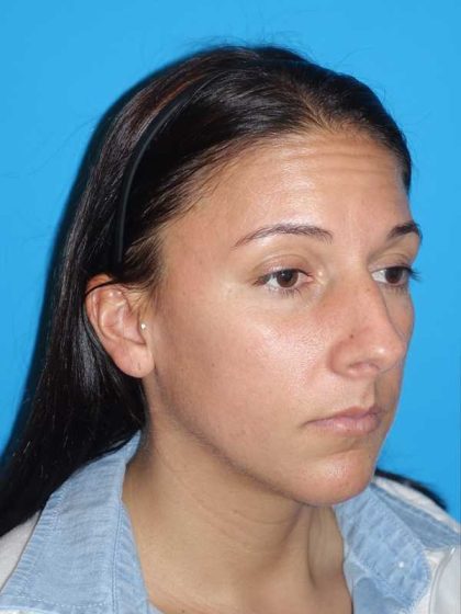 Rhinoplasty Before & After Patient #878