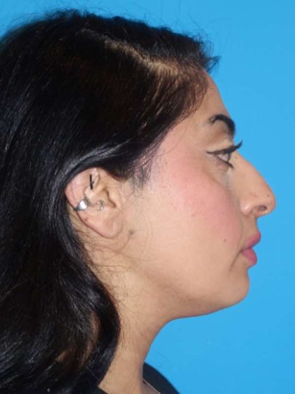 Rhinoplasty Before & After Patient #887