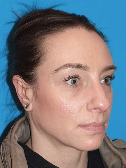 Rhinoplasty Before & After Patient #898