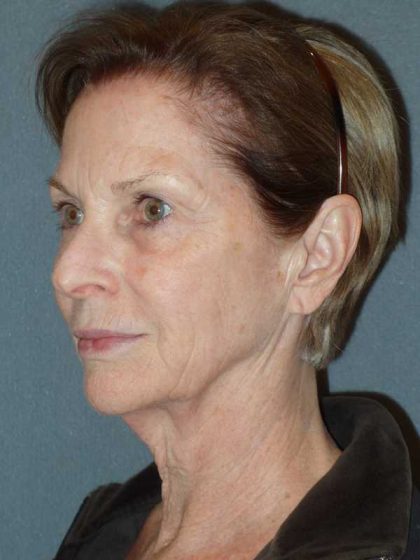 Deep Plane Lower Face & Neck Lift Before & After Patient #920