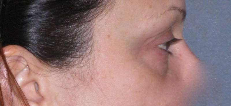 Fat Transfer Before & After Patient #715