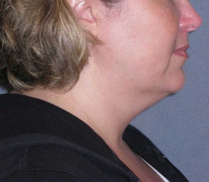 Deep Plane Lower Face & Neck Lift Before & After Patient #947