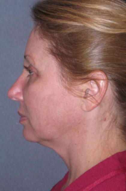 Deep Plane Mini Lift & Neck Lift Before & After Patient #981