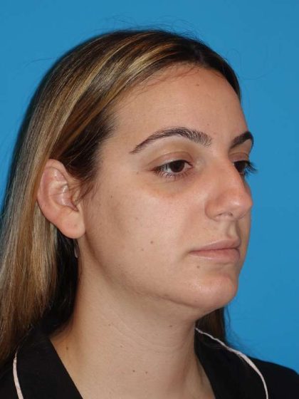 Neck Liposuction Before & After Patient #999