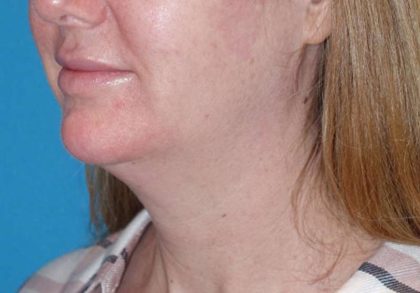 Neck Lift Before & After Patient #1018