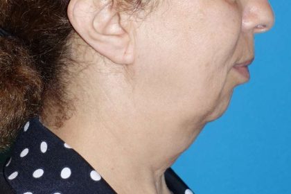 Deep Plane Lower Face & Neck Lift Before & After Patient #1041