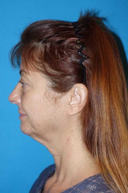 Deep Plane Lower Face & Neck Lift Before & After Patient #1052
