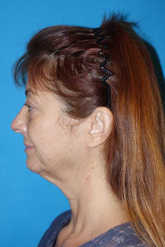 Deep Plane Lower Face & Neck Lift Before & After Patient #1052