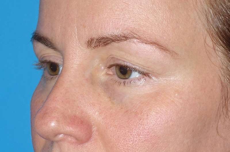 Eyelid Lift- Lower Before & After Patient #731
