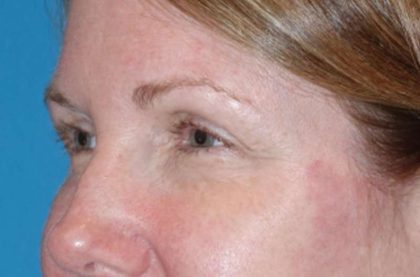 Eyelid Lift- Lower Before & After Patient #742