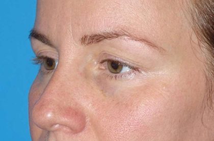 Eyelid Lift- Upper Before & After Patient #765