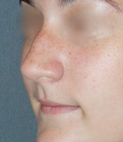 Rhinoplasty Before & After Patient #787