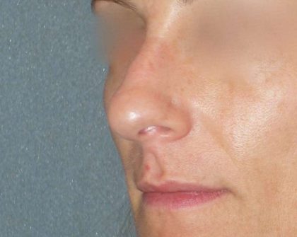Rhinoplasty Before & After Patient #798