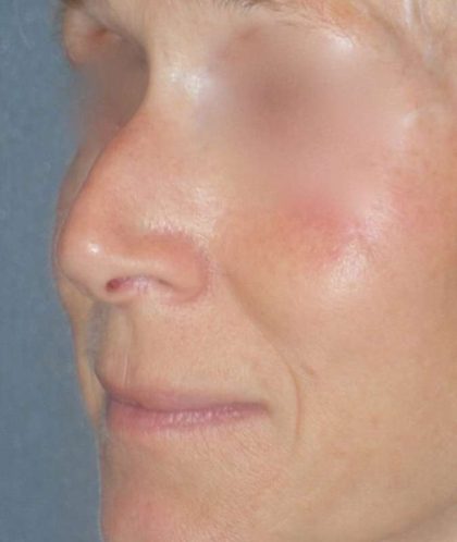 Rhinoplasty Before & After Patient #809