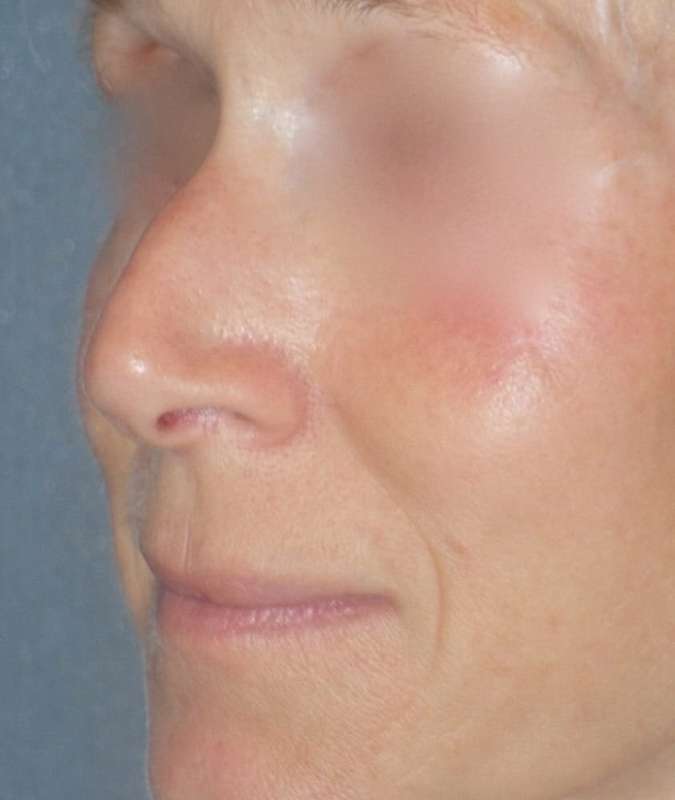Rhinoplasty Before & After Patient #809