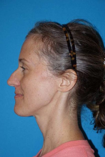 Rhinoplasty Before & After Patient #834