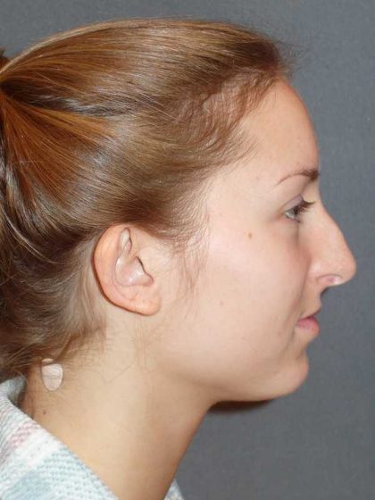 Rhinoplasty Before & After Patient #845