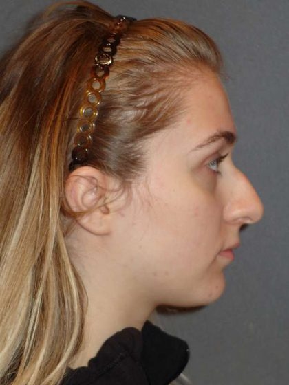 Rhinoplasty Before & After Patient #856