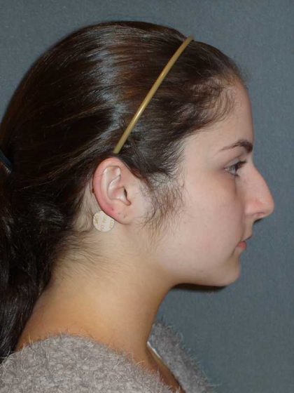 Rhinoplasty Before & After Patient #867