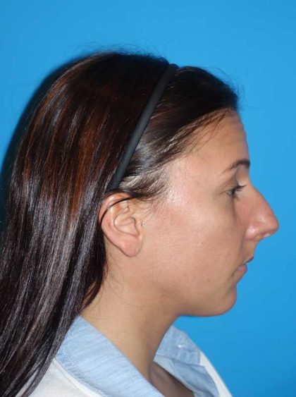 Rhinoplasty Before & After Patient #878