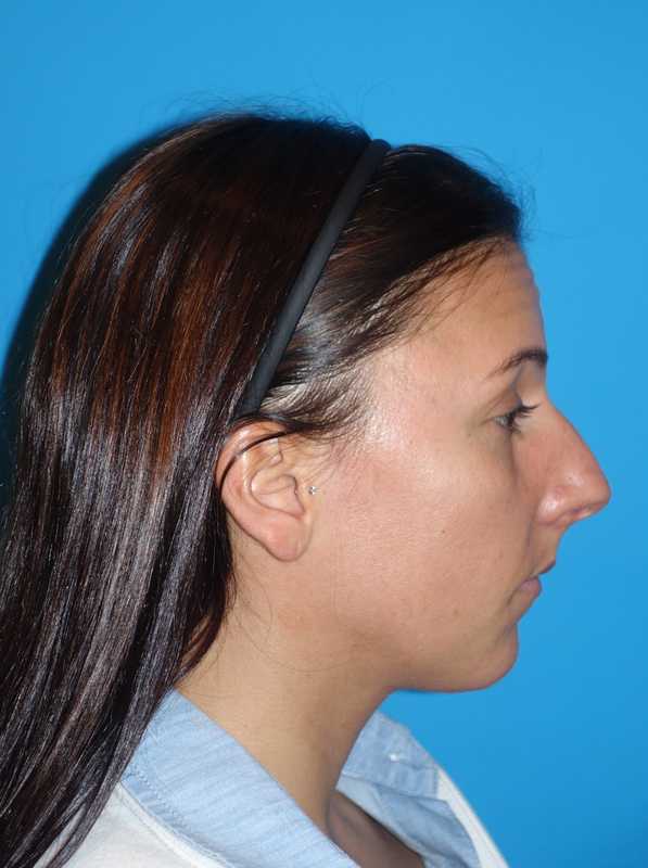 Rhinoplasty Before & After Patient #878