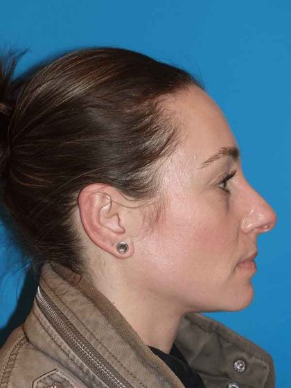 Rhinoplasty Before & After Patient #898