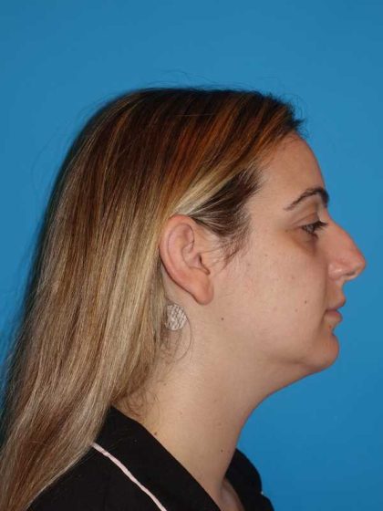 Rhinoplasty Before & After Patient #909