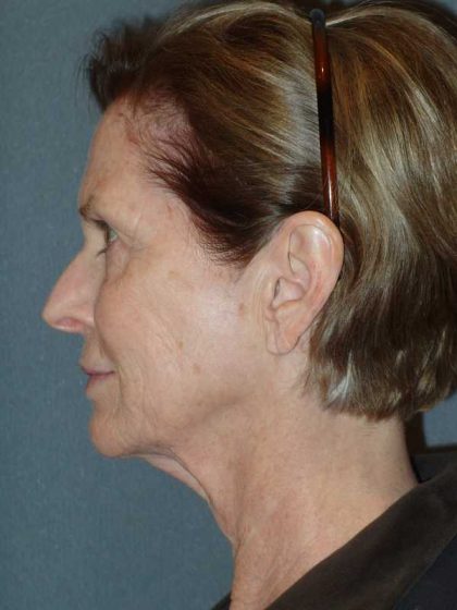 Deep Plane Lower Face & Neck Lift Before & After Patient #920