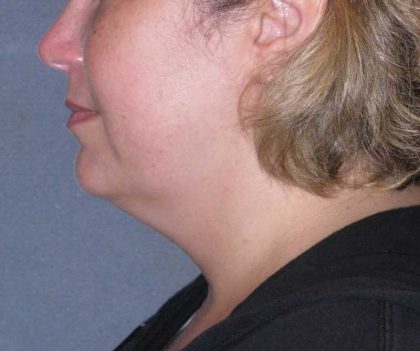 Deep Plane Lower Face & Neck Lift Before & After Patient #947