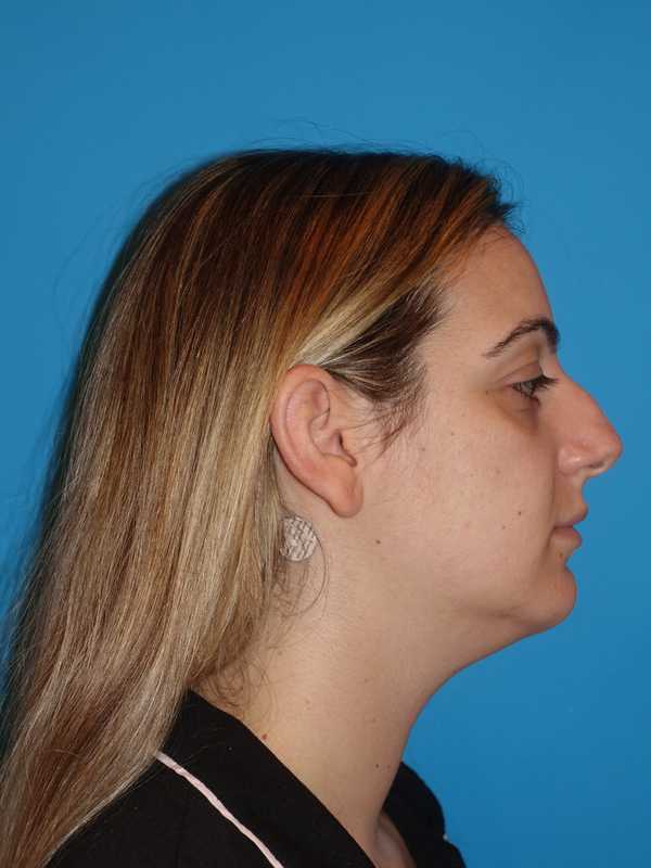 Neck Liposuction Before & After Patient #999