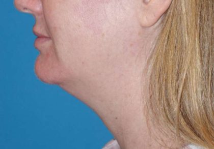 Neck Lift Before & After Patient #1018