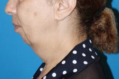 Deep Plane Lower Face & Neck Lift Before & After Patient #1041