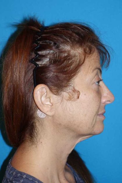 Deep Plane Lower Face & Neck Lift Before & After Patient #1052
